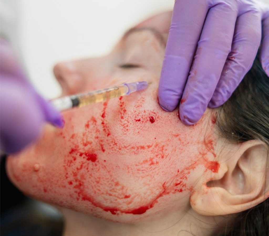 face non inject prp