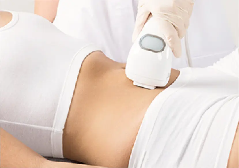 laser stretchmark laser stretchmark