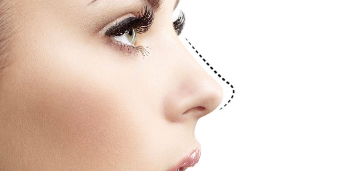 Botox Cuping Hidung