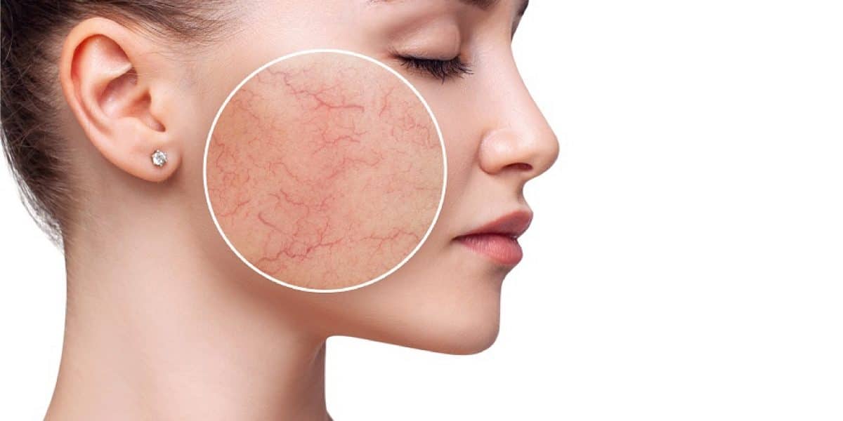 Blemish atau blemishes adalah