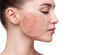Blemish atau blemishes adalah