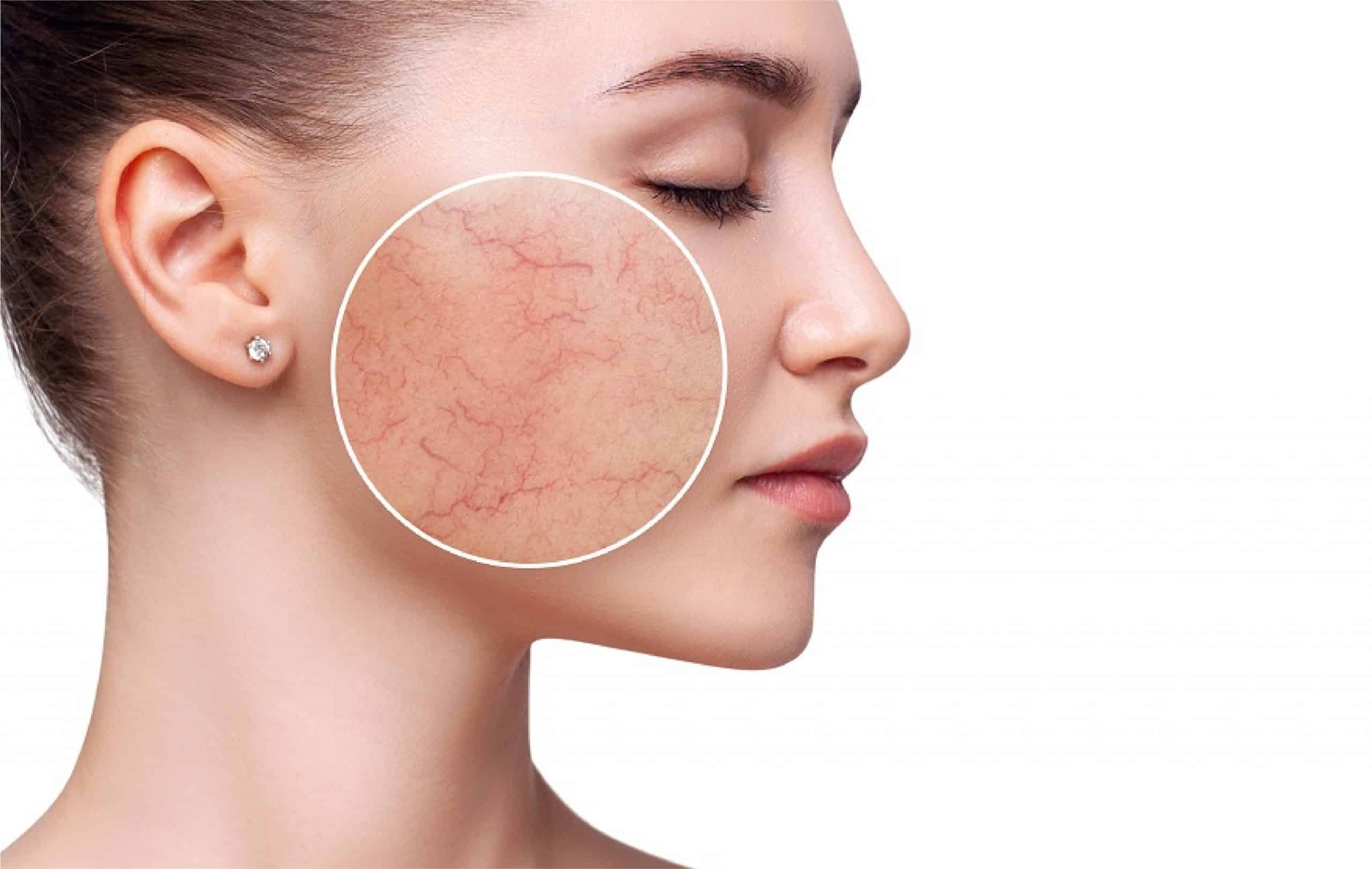 Yellow Laser, Treatment Terbaik untuk Permasalahan Kulit Anda