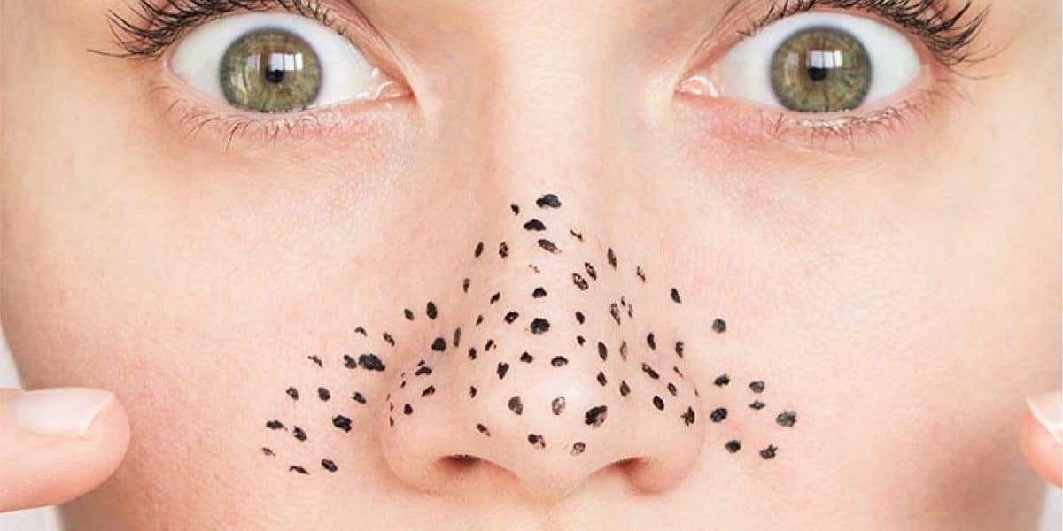 Cara Menghilangkan Komedo Hidung