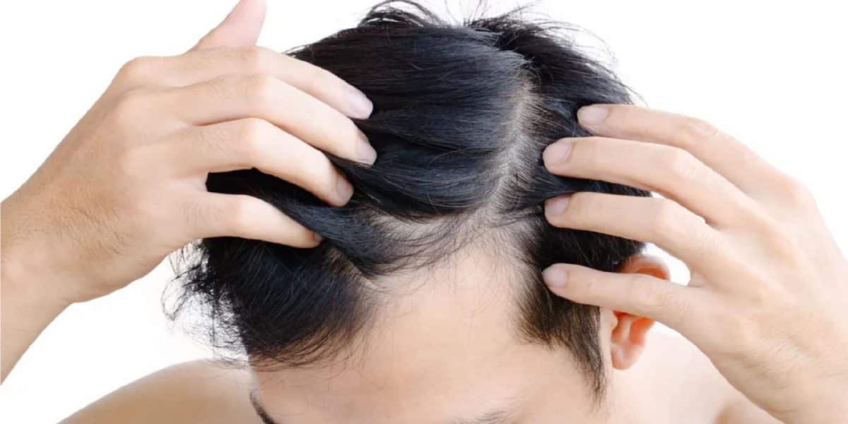 Cara menebalkan rambut pria