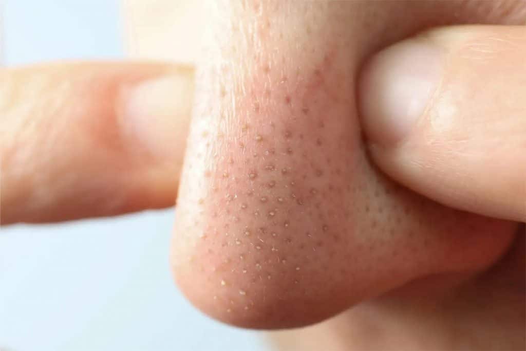 cara mengecilkan pori pori di hidung