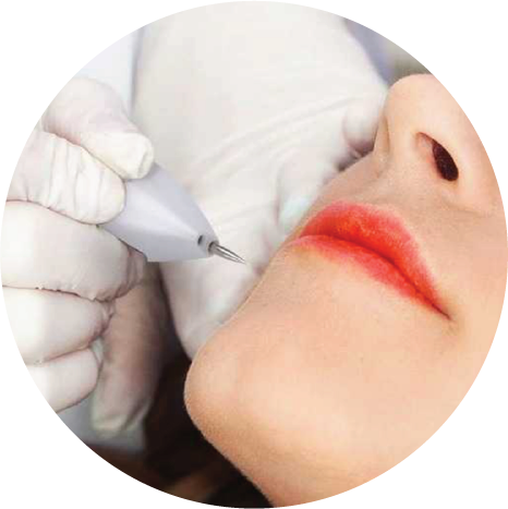 plasma laser