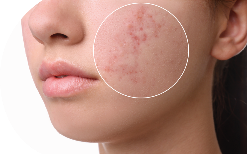 acne infus acne infus