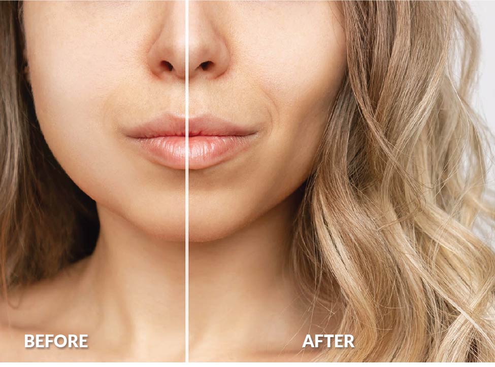 buccal fat buccal fat